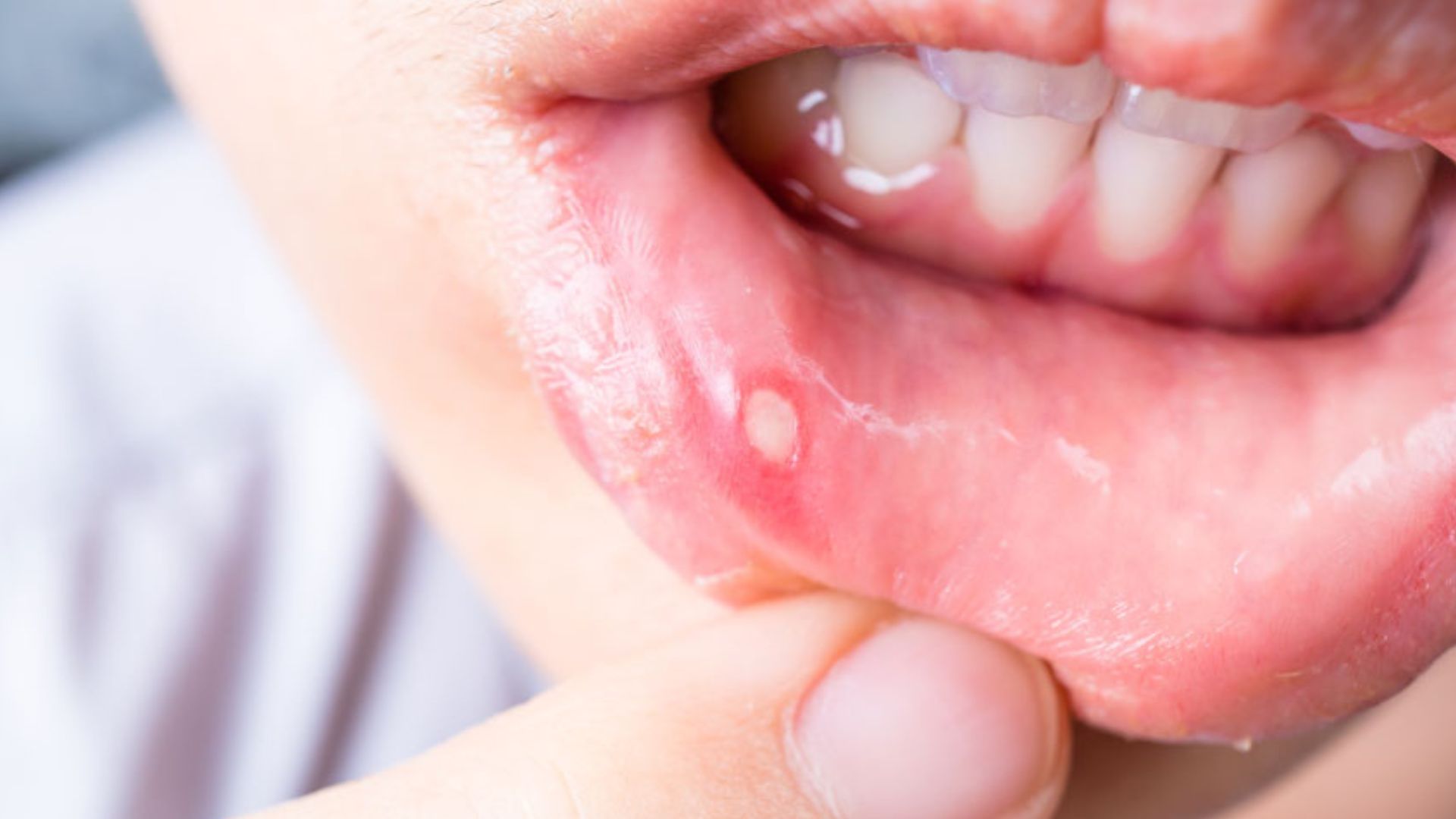 At-Home Tips to Heal Cold Sores
